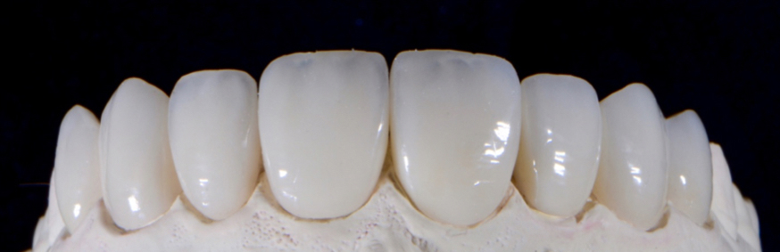 Close-up of feldspathic veneers on a model showing natural contour and translucency, used for cosmetic dentistry comparison between feldspathic and Emax materials. Fabricated by Styledent Dental Laboratory.